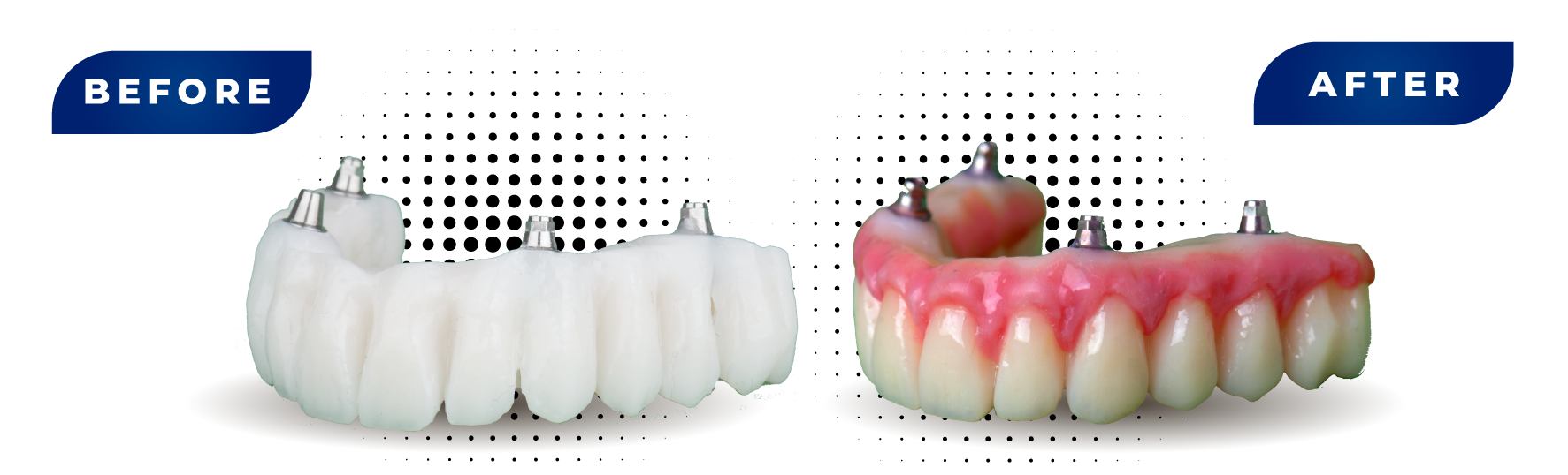 Nanoksa Ginigiva Before and After
